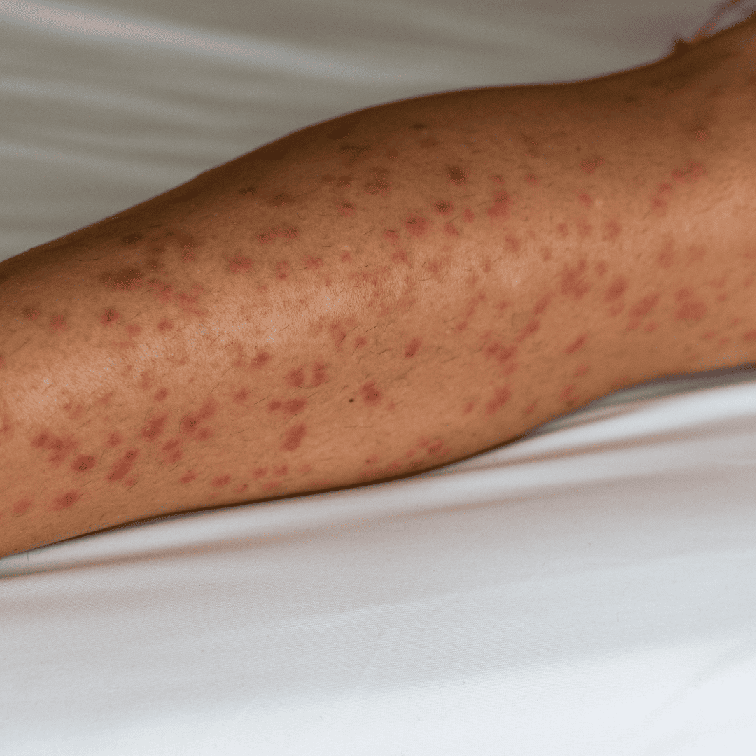 Bites on Your Skin | Bed Bug Texas Termite & Pest Control