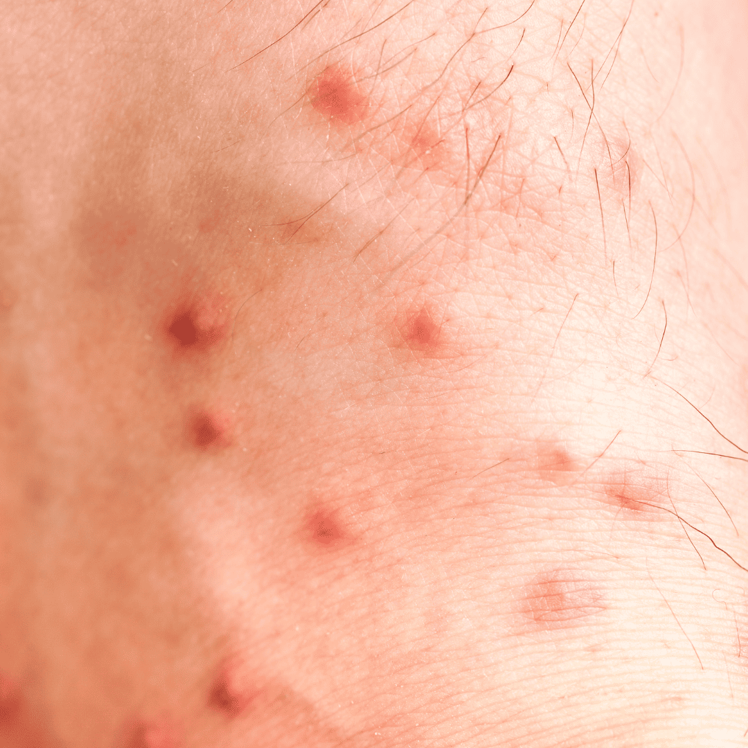 Yard Pests Control 11 Tick Bites | Bed Bug Texas Termite & Pest Control